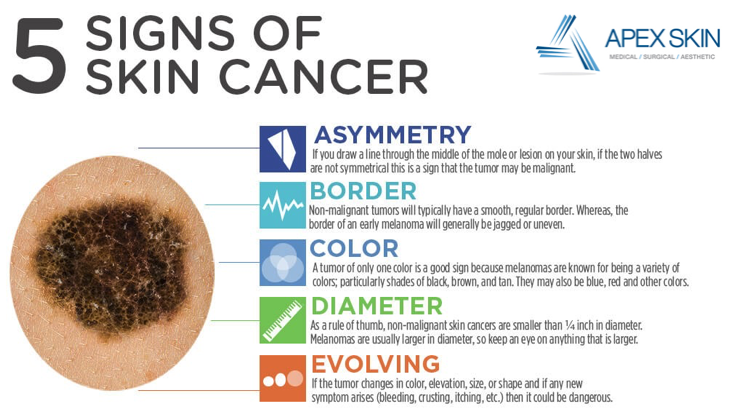 5-signs-of-skin-cancer