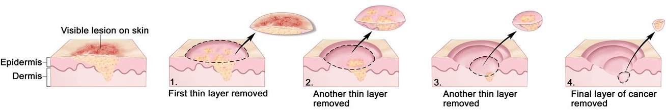mohs surgery