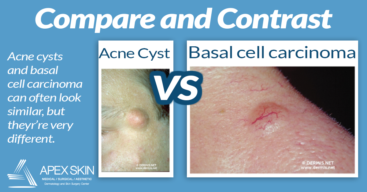 acne cyst versus skin cancer