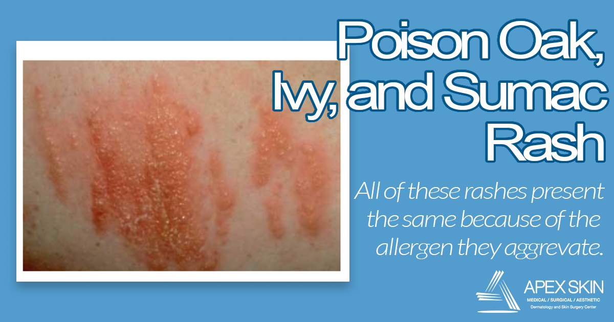 poison oak rash
