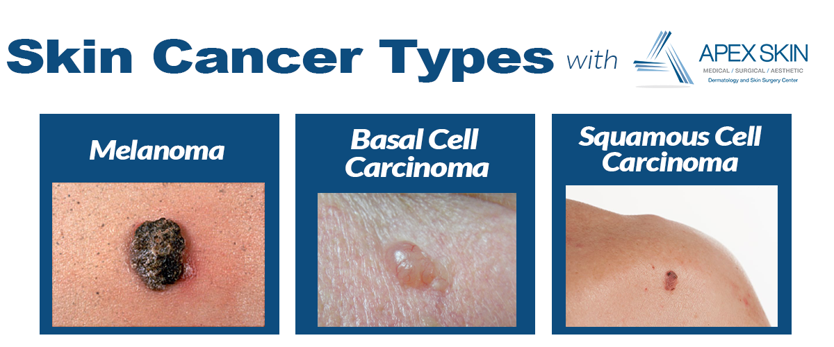 skin cancer types