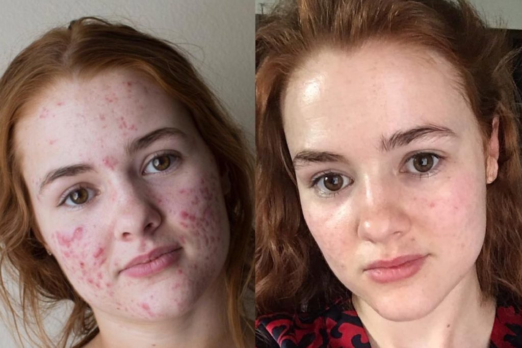 accutane before and after