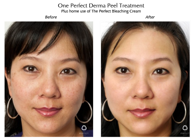 perfect derma peel before and after