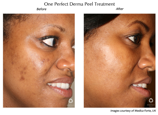 the perfect derma peel