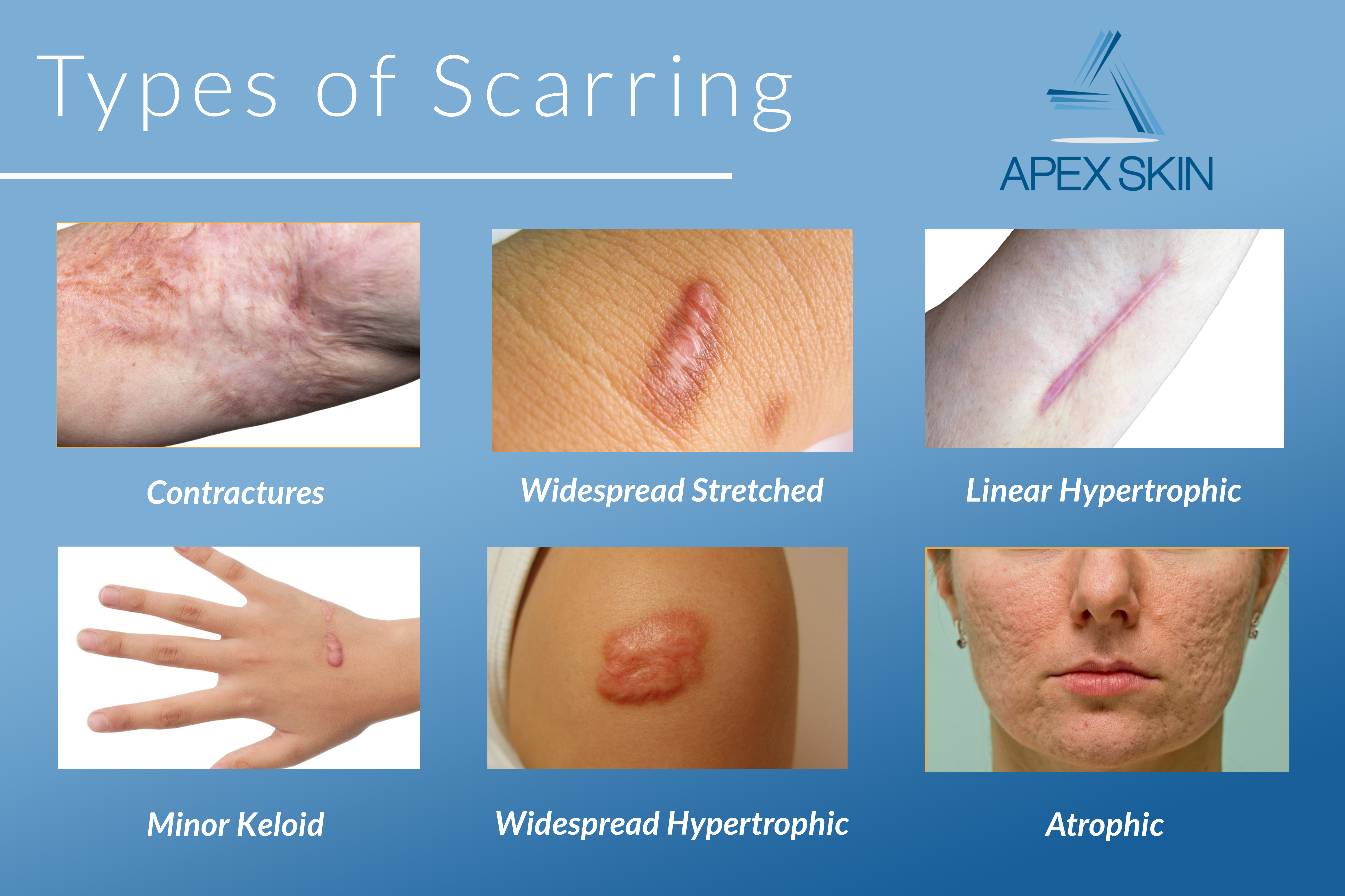 types of scars