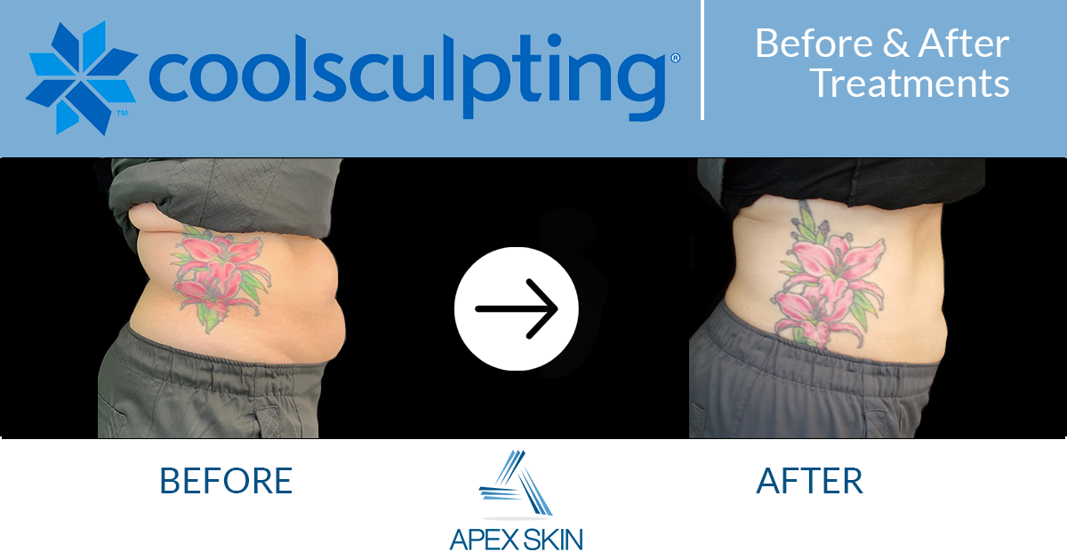 coolsculpting before after