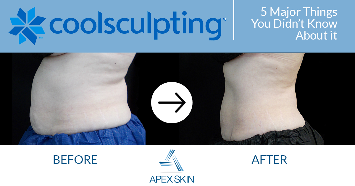 coolsculpting