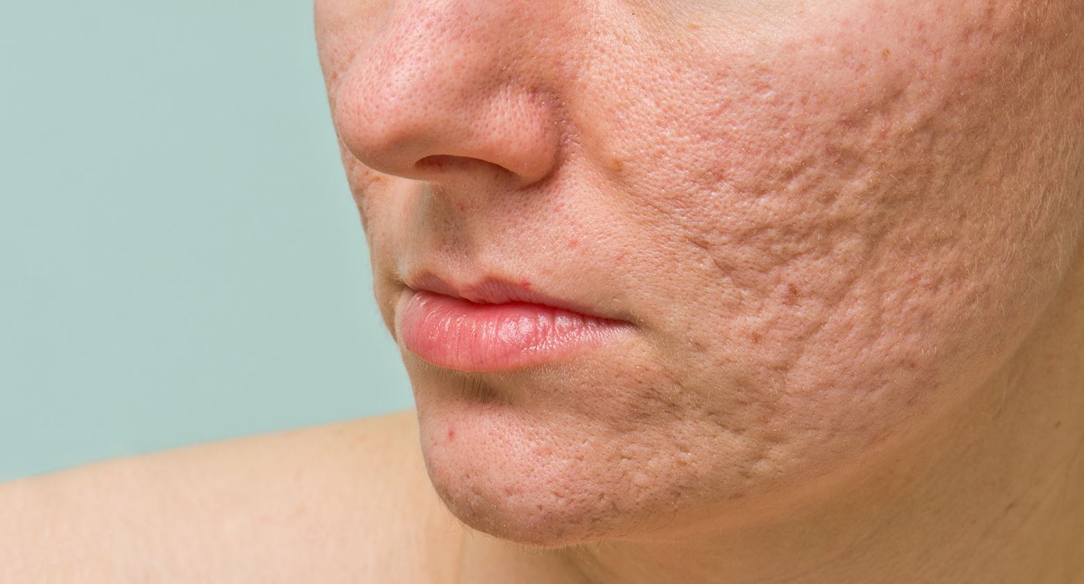 how to get rid of acne scars on back of thighs