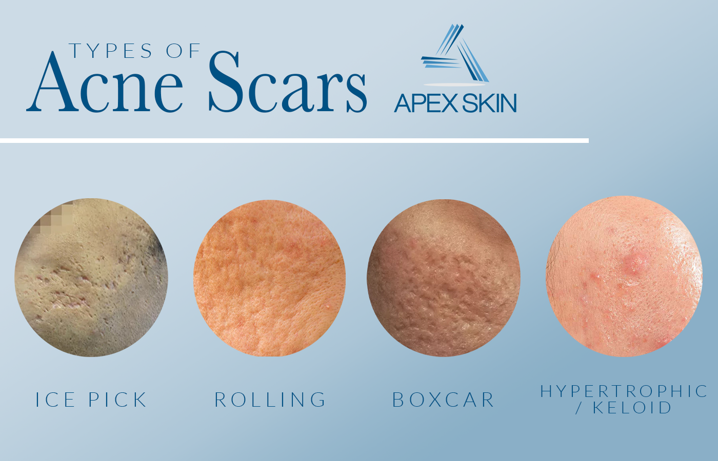 types of acne scars