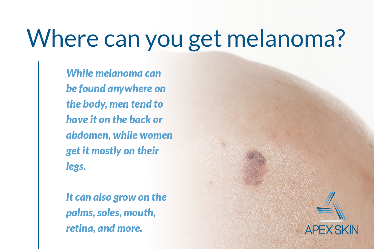 melanoma