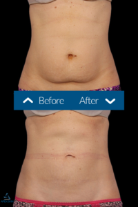 coolsculpting before and after