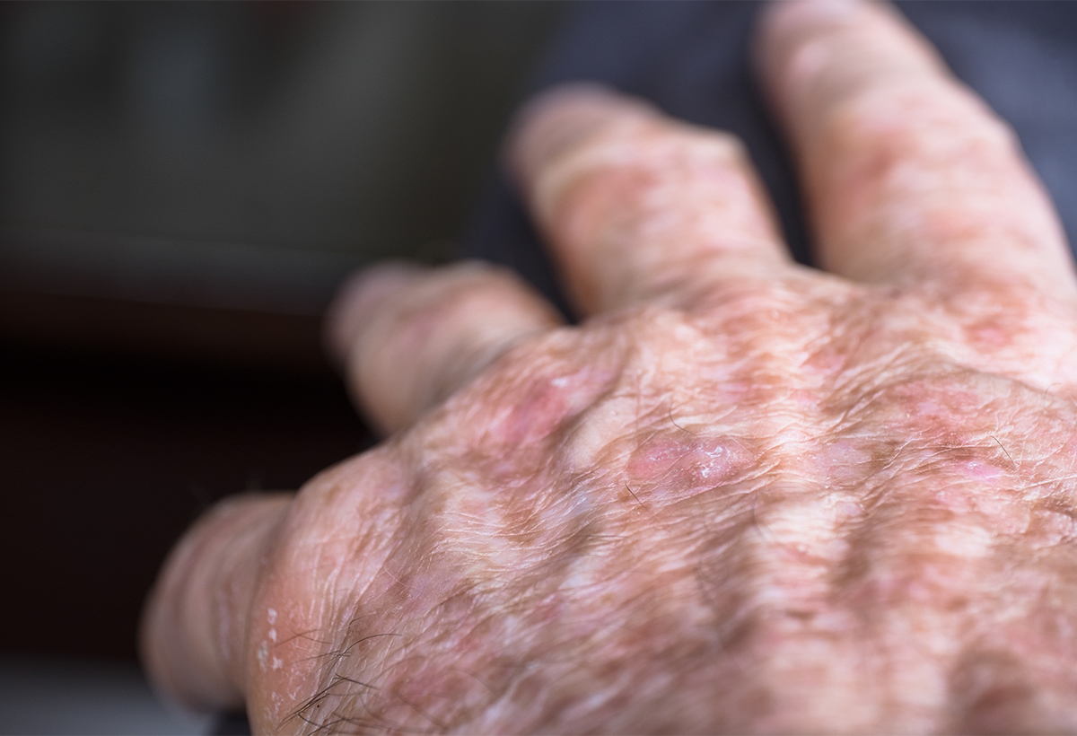 Most Common Skin Conditions for People 65 and Over – Apex Dermatology & Skin Surgery Center