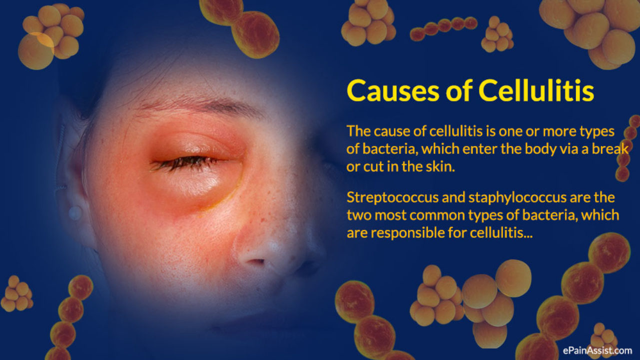 Staph Infection Vs Cellulitis At Elijah Rosa Blog