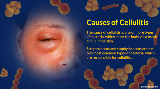 Cellulitis