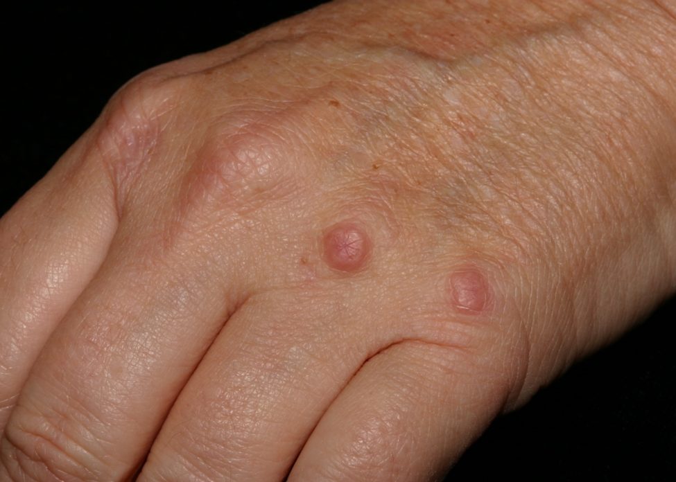 Granuloma