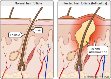 Folliculitis (Infections) - Apex Dermatology & Skin Surgery