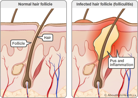 Folliculitis (Infections) - Apex Dermatology & Skin Surgery Folliculitis (Infections) - Apex Dermatology & Skin Surgery
