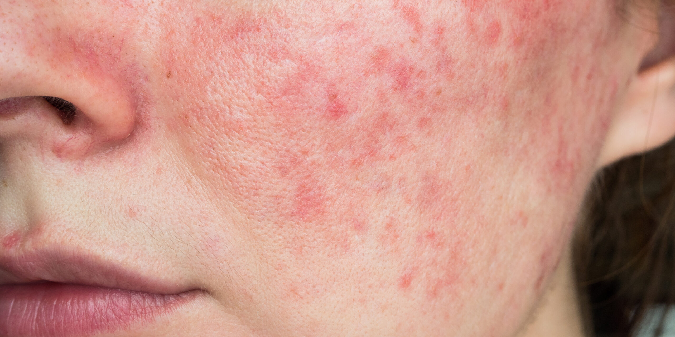 papulopustular rosacea, close-up of the patient’s cheek Rosacea