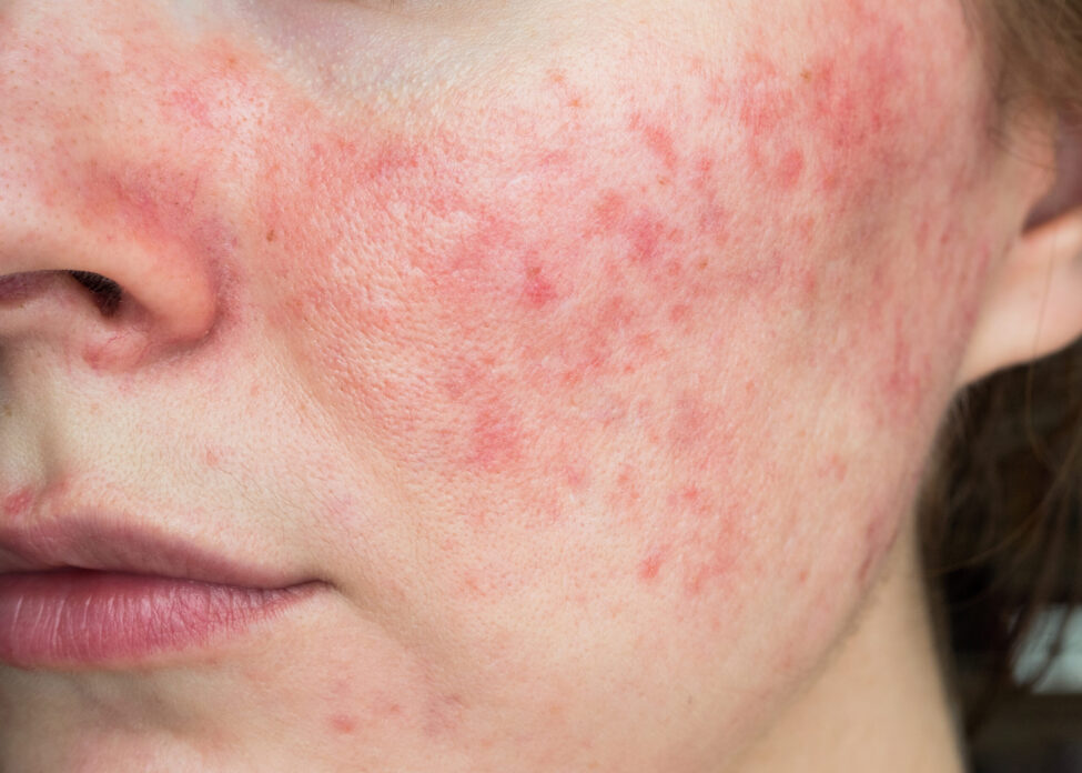 papulopustular rosacea, close-up of the patient’s cheek Rosacea