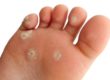 Warts