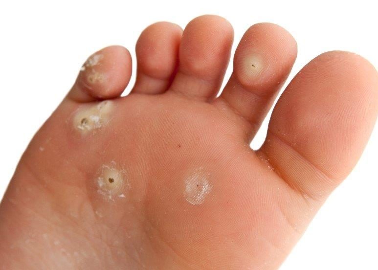 Warts