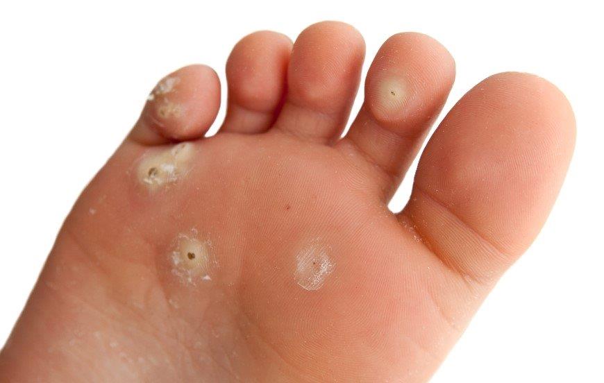 wart on foot of child om antihelmintic