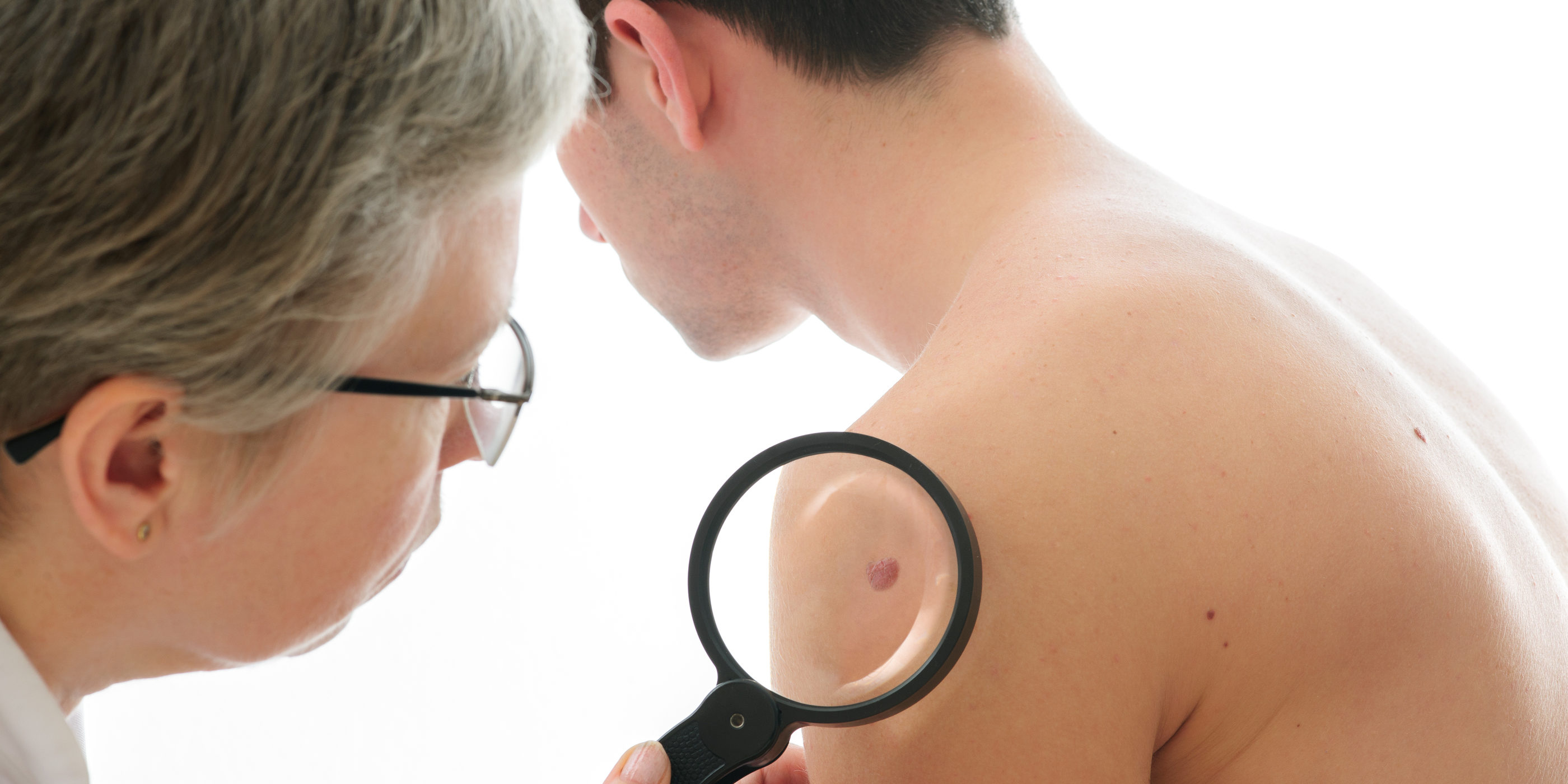 Cancerous moles