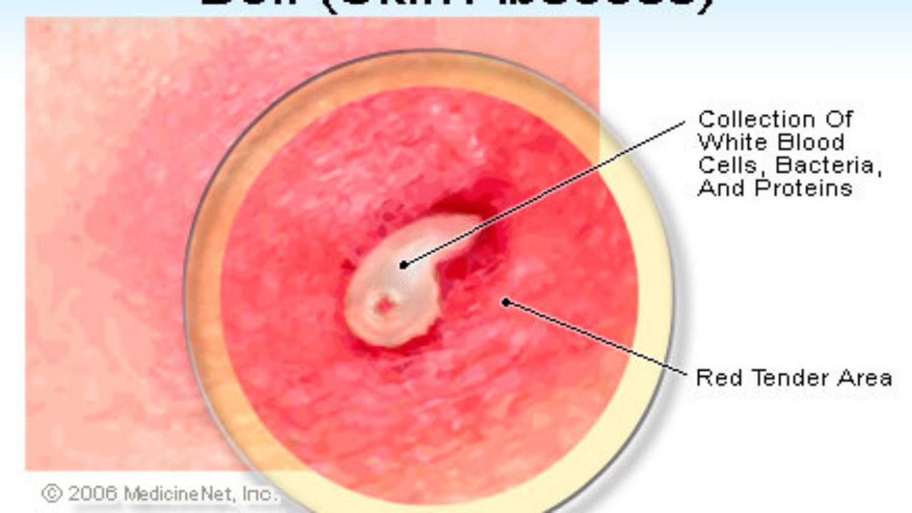 How To Paint Pustules and Boils