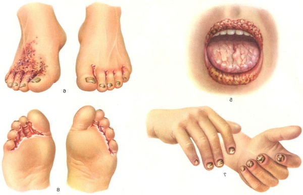 Candidiasis (Infections) - Apex Dermatology & Skin Surgery