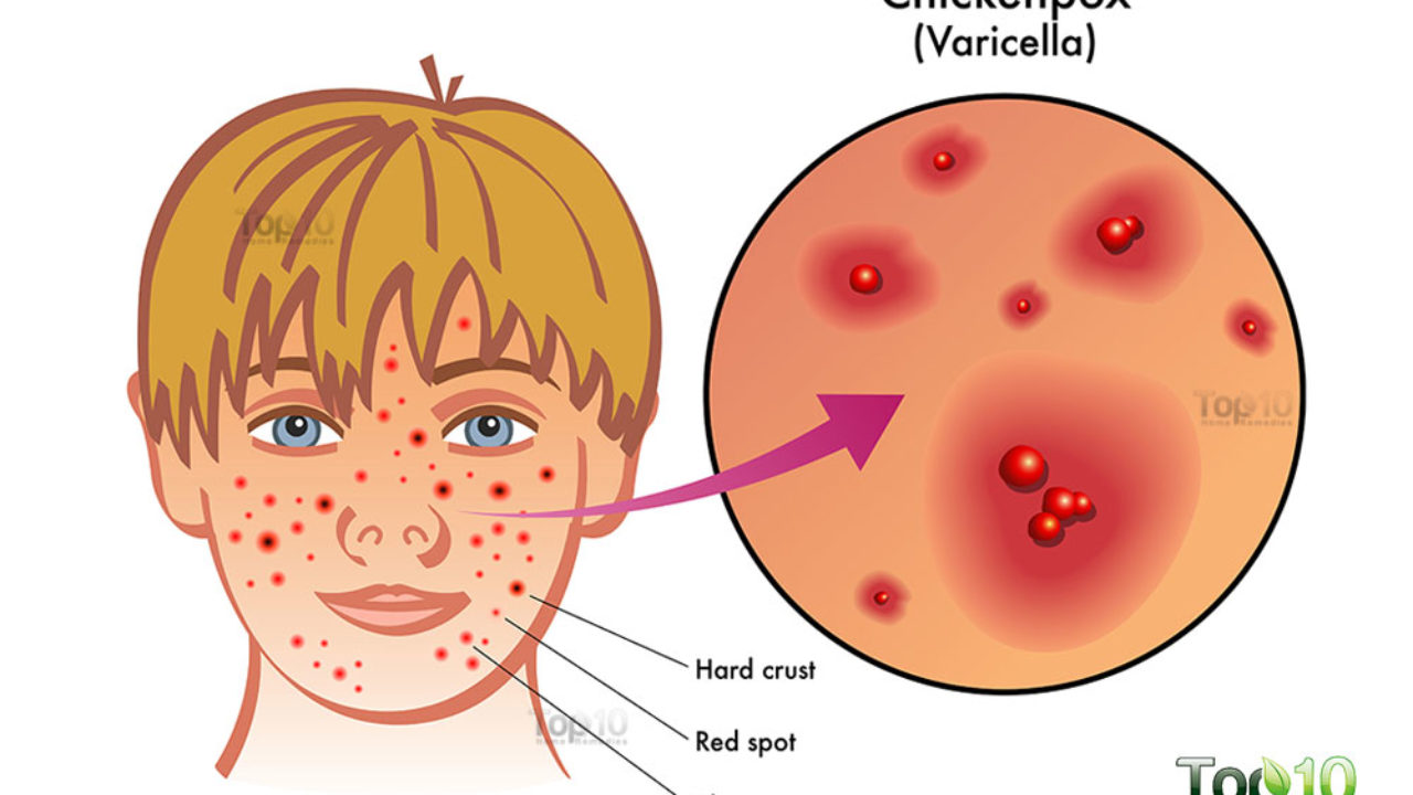 Varicella adalah