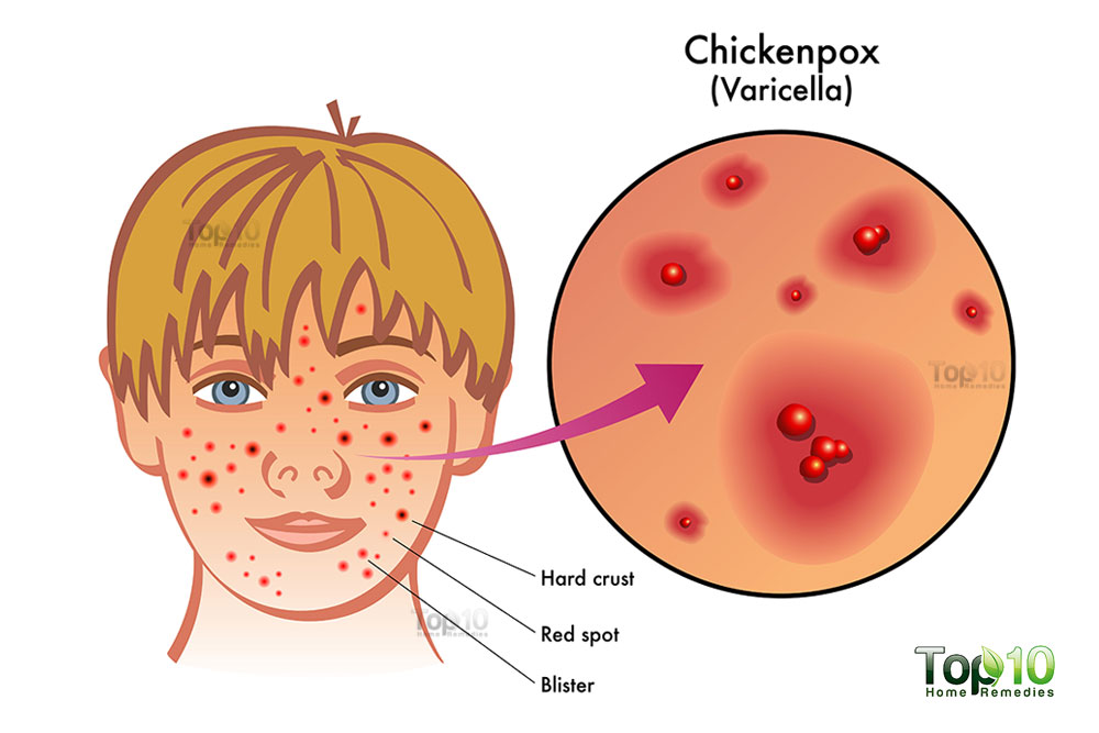 Chicken pox in malay