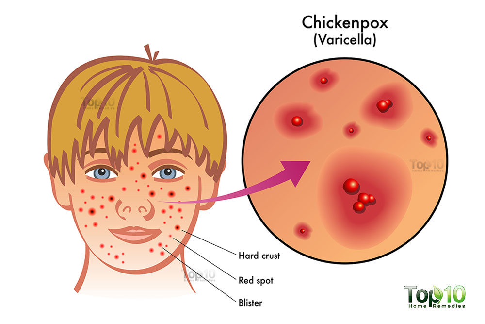 Chicken Pox Infections Apex Dermatology And Skin Surgery