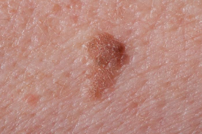 Seborrheic Keratosis Apex Dermatology And Skin Surgery