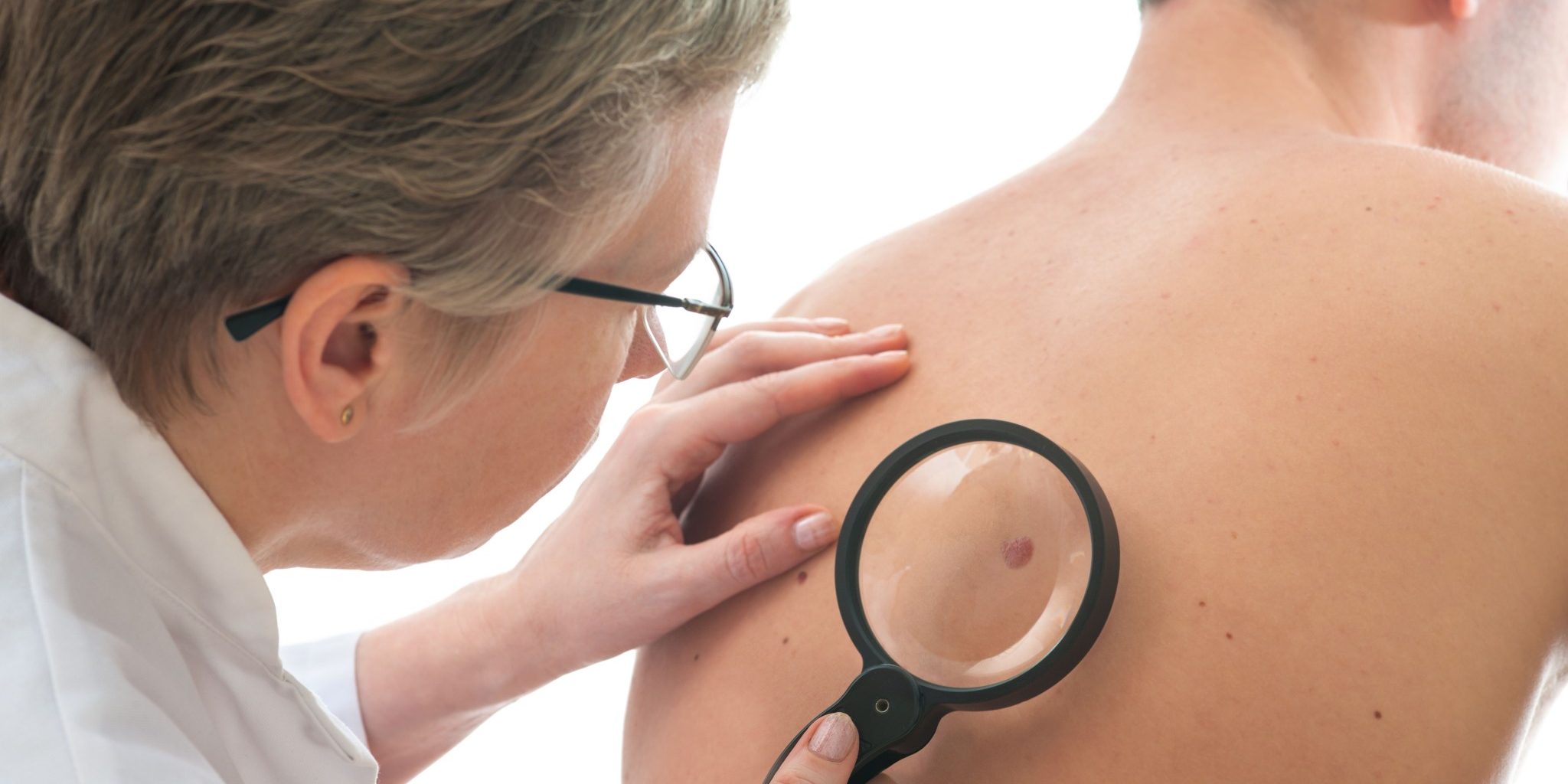 how-to-spot-skin-cancer