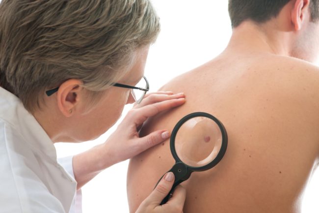 how-to-spot-skin-cancer