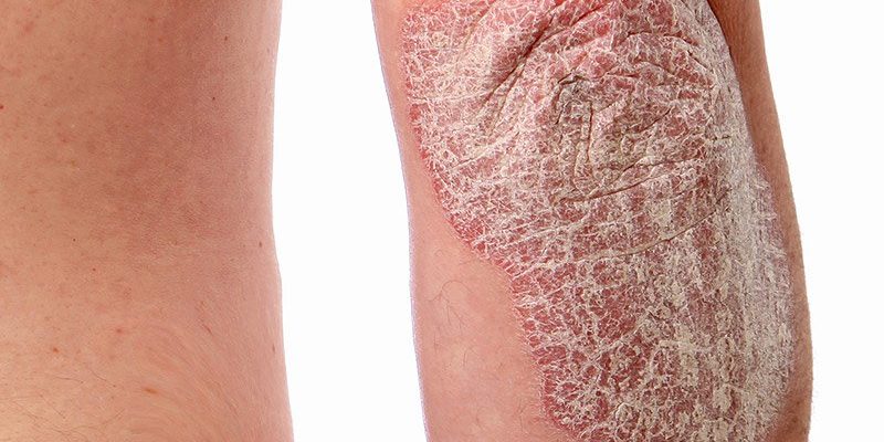 psoriasis