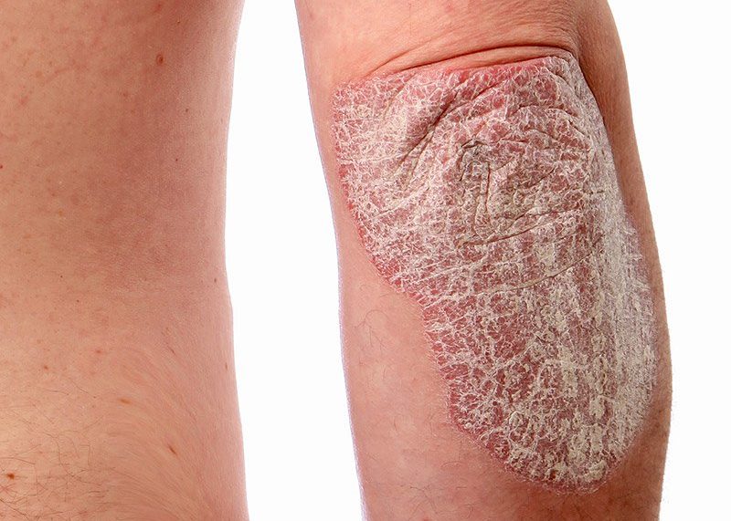 psoriasis
