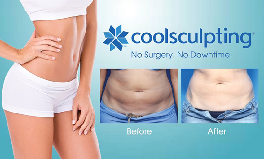 5 Things You Didn't Know About CoolSculpting - Apex Dermatology & Skin  Surgery Center - Cleveland, OH Dermatology