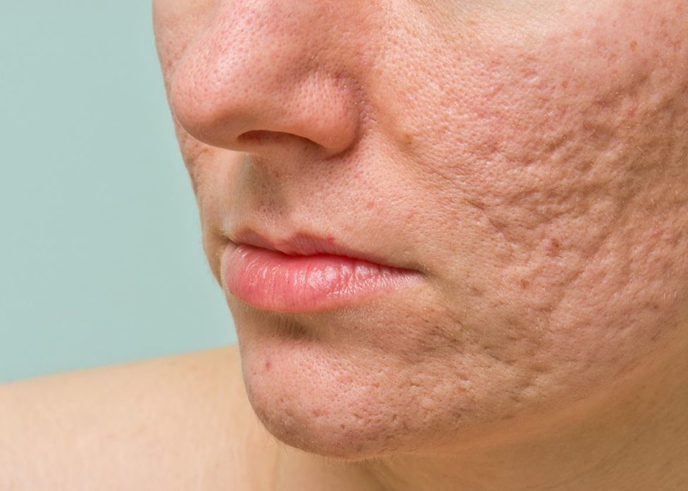 how to get rid of acne scars