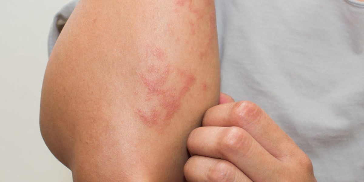 new-in-covid-19-skin-rashes-linked-to-virus-apex-dermatology-skin