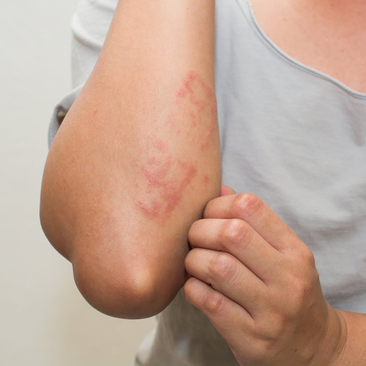 NEW in COVID-19: Skin Rashes Linked to Virus - Apex ...