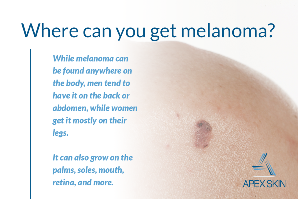 Melanoma: A Skin Cancer Expert Shares What You Need to Know About the ...