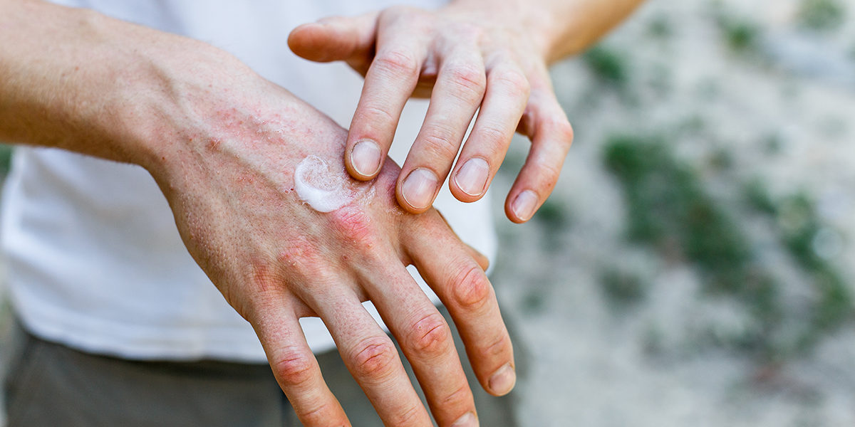 hand dermatitis