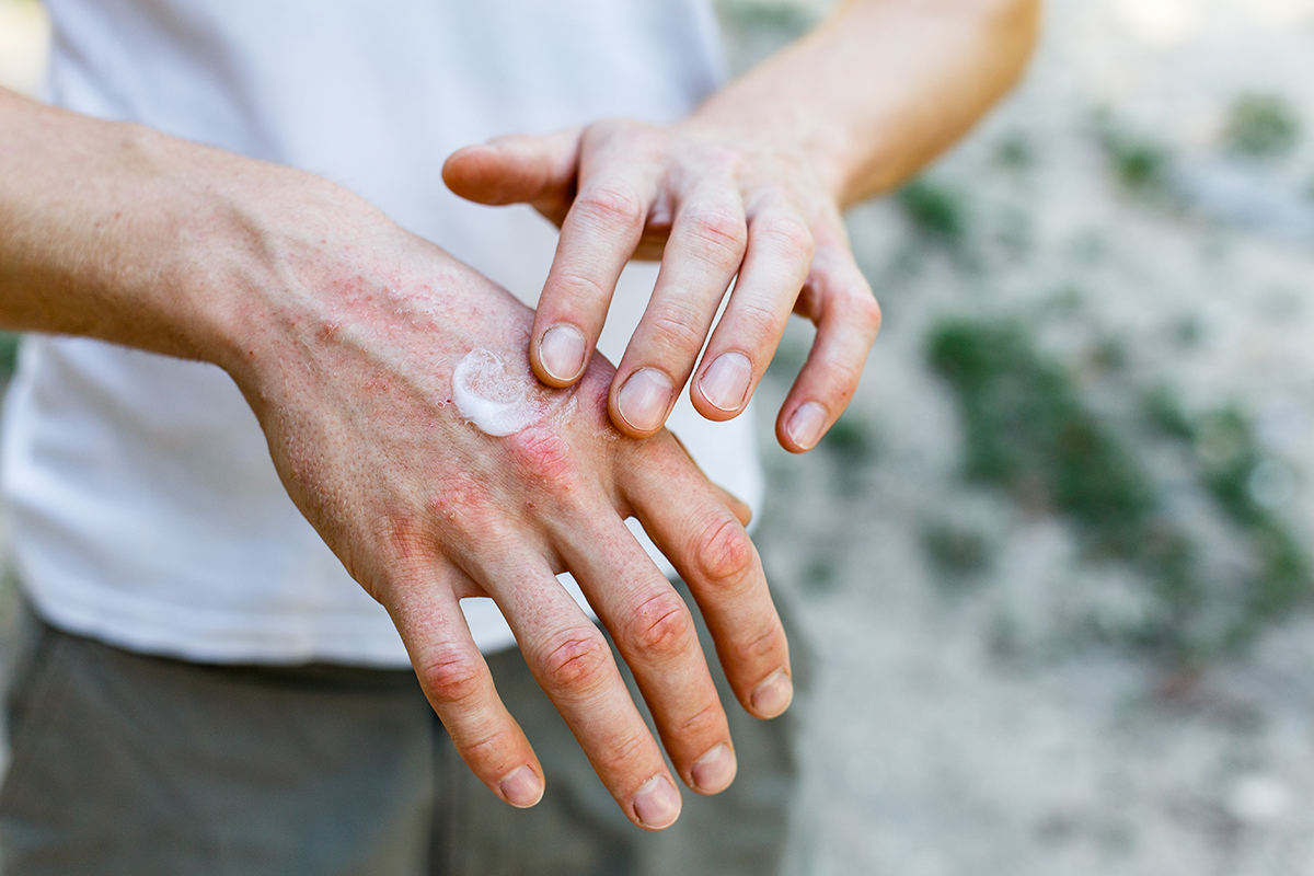 Hand Dermatitis: Understanding, Preventing, & Treating Dry Skin - Apex Dermatology & Skin Surgery Center - Cleveland, OH Dermatology