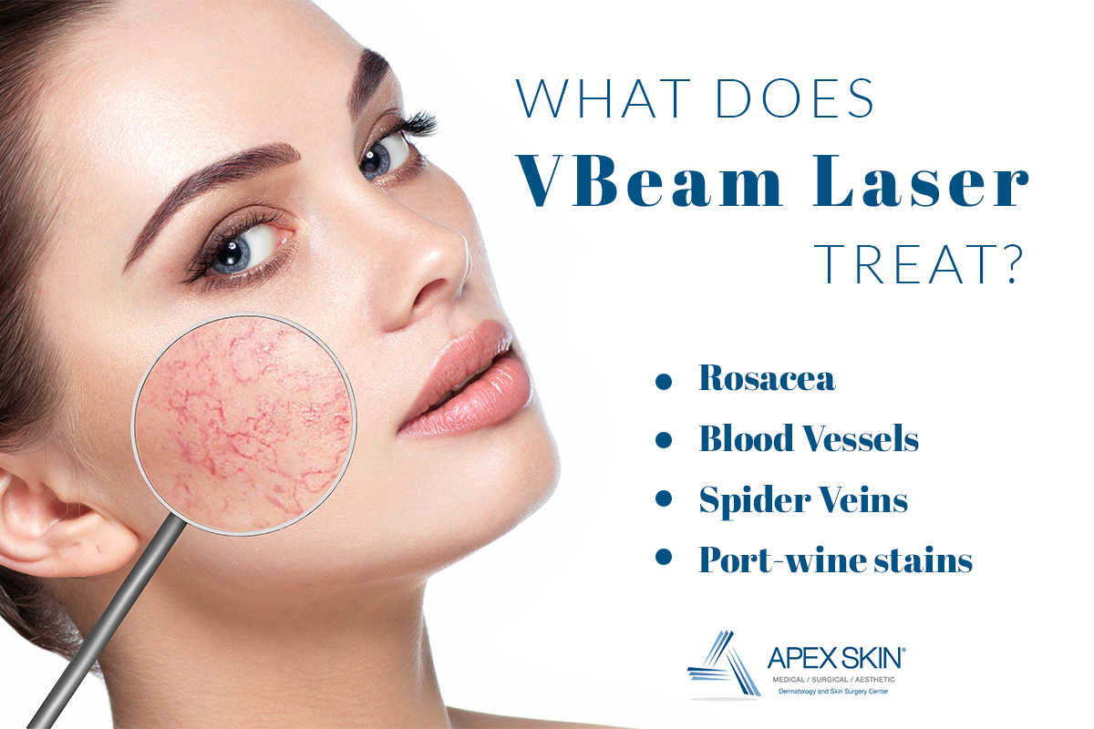 what does vbeam treat
