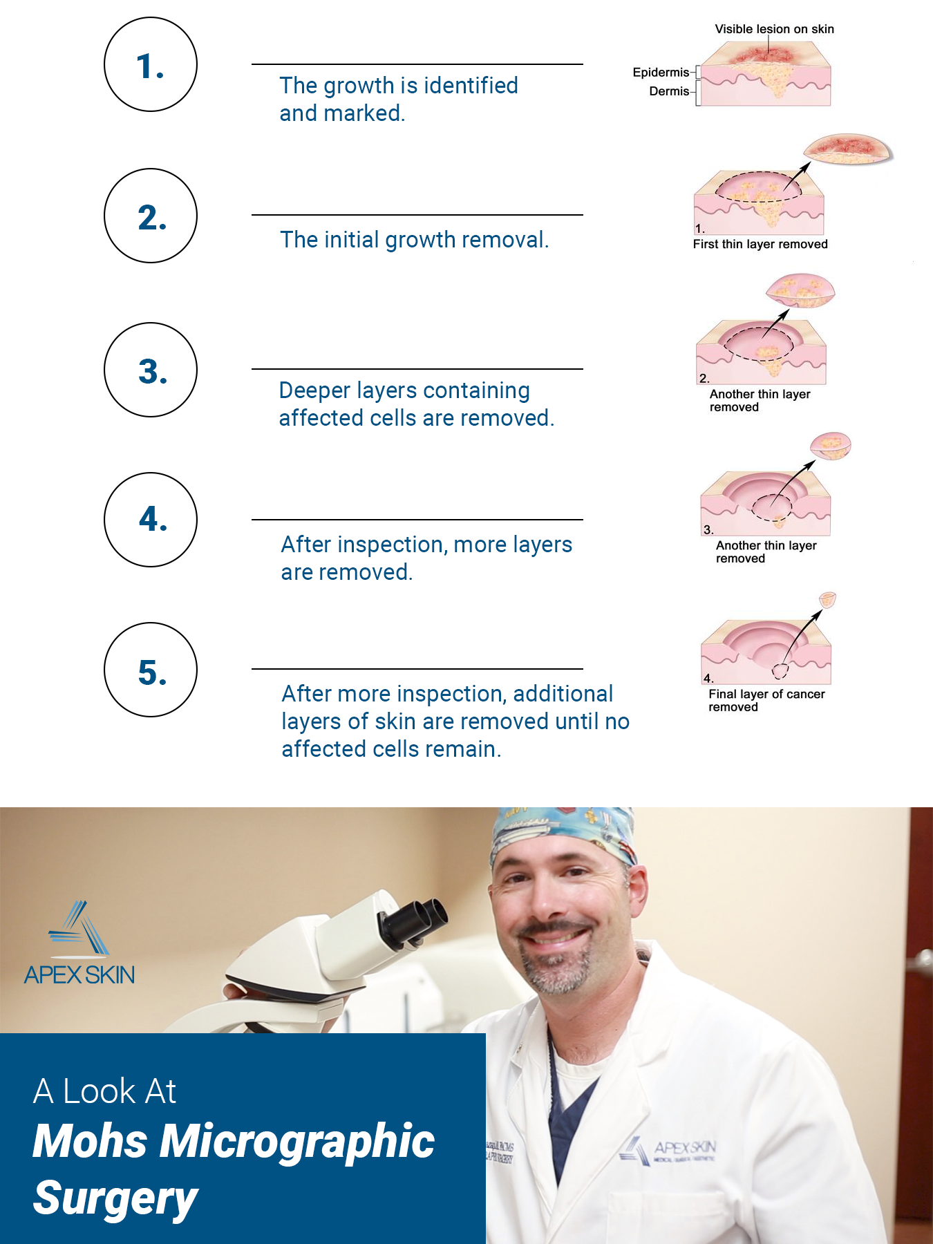 micrographic surgery