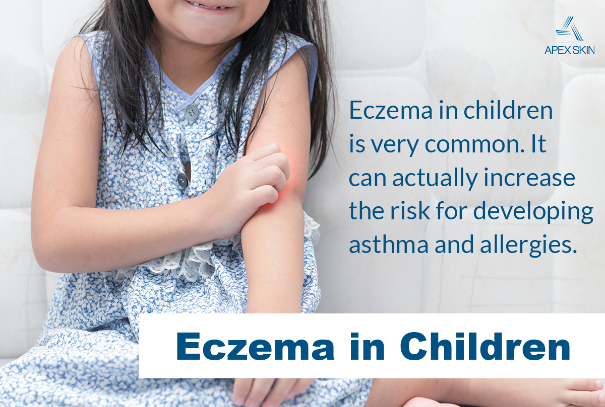eczema in children eczema in children
