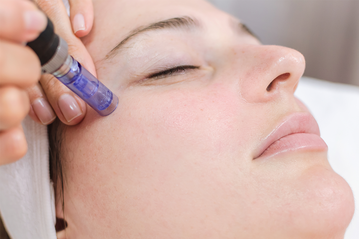 Microneedling Treatment - Apex Dermatology