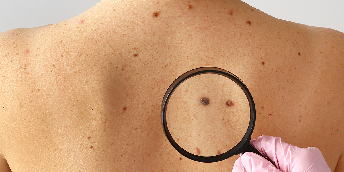 remove skin cancer remove skin cancer