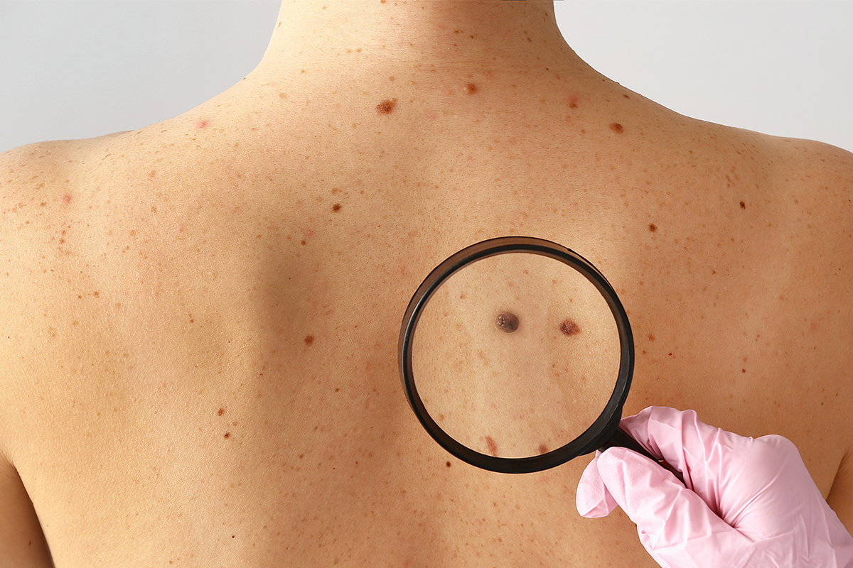 What does skin cancer look like